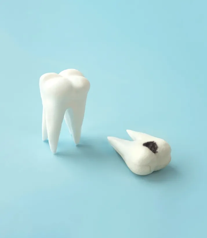 Des caries de différents stades