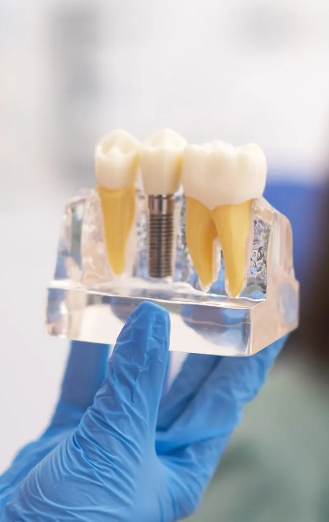 Implants : une solution polyvalente et durable